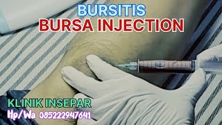 BURSITIS  BURSA INJECTION  ruralhealthcare syarhan [upl. by Adnalay]