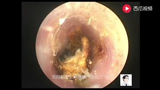 Earwax Removal Extraction Cholesteatoma of the middle ear canal exfoliate of tympanic membrane [upl. by Pietro]