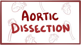 Aortic Dissection  causes symptoms diagnosis treatment pathology [upl. by Blackington]