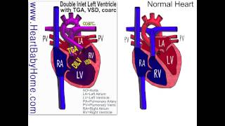 42 Double Inlet Left Ventricle with TGA vsd coarc [upl. by Reaht]