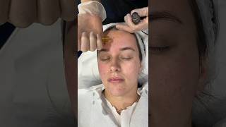 Microneedling with PRP  Dr Medispa [upl. by Trixie990]