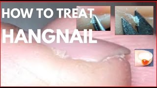 How to treat hangnails Agnail treatment [upl. by Inahteb]