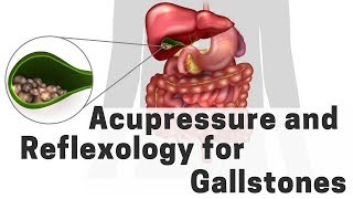 Acupressure and Reflexology for Gallstones  Massage Monday 385 [upl. by Oicnerolf522]