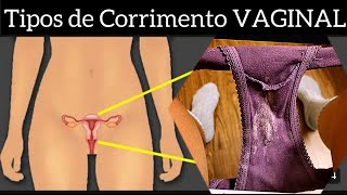 CORRIMENTO VAGINAL BRANCO CINZENTO ESVERDIADO  AMARELADO E VERMELHO acompanhado de mal cheiro [upl. by Bryon]