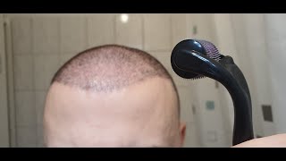 Minoxidil amp Dermarolling Results 6 MONTHS  Month by Month Progress [upl. by Avram62]