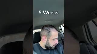 Hair Transplant Process  Week by Week  3 Months [upl. by Niamor572]