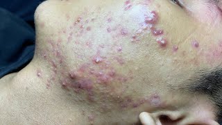 ACNE TREATMENT VU QUYNH MI Blackheads On Boy Face 2024 [upl. by Uile]