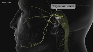 Trigeminal Neuralgia local doctors may have found the cure [upl. by Odravde808]