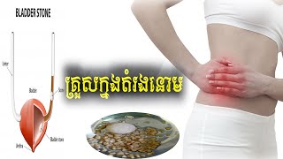 ជម្ងឺគ្រួសតម្រងនោម​  Lithiasis Renal or Calcul Renal [upl. by Eelyma]