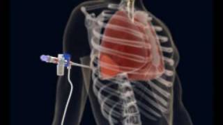 How to make a Thoracentesis pleural puncture with Pleurasafe [upl. by Oirobil]