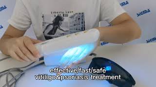 SIGMA SH1BJ product display 311nm UVB phototherapy device vitiligo psoriasis treatment lamp [upl. by Arata]