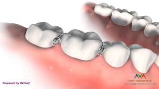 Orthodontic Separator or Spacer  Metal Helix [upl. by Adnamas]