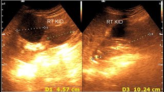 Renal cortical cyst  Milk of calcium cyst  Renal calcification [upl. by Lyrrehs]