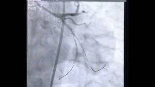 Case 9 Bifurcation stenting of LCXOM1 by nanocrush technique [upl. by Hillari]