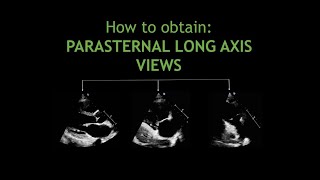 How to obtain PARASTERNAL LONG AXIS VIEWS [upl. by Brunella]