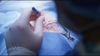 Strabismus Eye Surgery  Inside the OR [upl. by Micky]