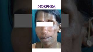 Morphea  एक ऐसी बिमारी जो चेहरे के मांस को सूखा देती है [upl. by Care]