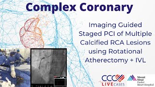 Imaging Guided Staged PCI of Multiple Calcified RCA Lesions using Rotational Atherectomy  IVL [upl. by Gally]