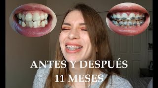 MI EXPERIENCIA CON BRACKETS  AVANCE 11 MESES ANTES Y DESPUÉS [upl. by Baptiste]