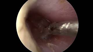 Ear tube placement myringotomy [upl. by Yecad953]