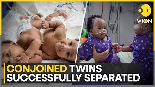 Conjoined Twins Successfully Separated After 8Hour Long Surgery  World News  WION [upl. by Salvidor]