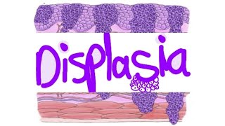 pathology Displasia and carcinoma in situ  intraepithelial carcinoma [upl. by Rebeca514]