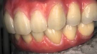 BioHPP ePlant Bredent Beever Dental Screw retained [upl. by Rebmyk975]