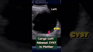 Large Ovarian Cyst in Mother with Normal Pregnancy of 33 wks ultrasound pregnancy baby [upl. by Ocsirf282]