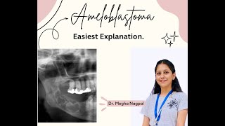 Ameloblastoma01  Easiest Explanation  Oral Pathology  BDS [upl. by Lawan]