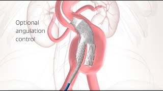 Abdominal ACTIVE CONTROL Animation [upl. by Sorel]