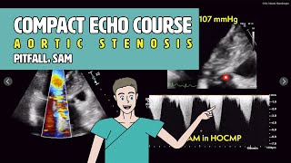 〖Echocardiography〗 LVOT obstruction amp SAM  pitfalls in aortic stenosis 🚨 [upl. by Glover789]