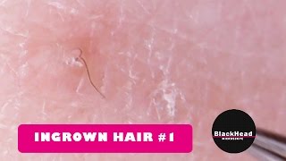 Ingrown Hair RemovalExtraction 1 [upl. by Bennet]