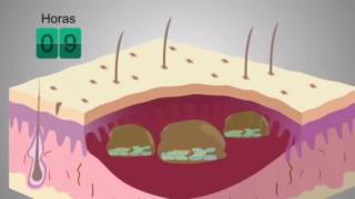 Vídeo explicativo sobre los Biofilms y como actúa Prontosan [upl. by Htir]