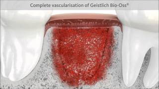 Geistlich Bio Oss [upl. by Einimod875]