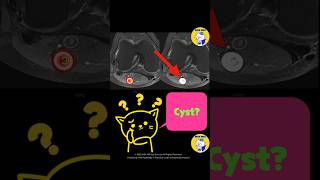 Fig 4D19 Schwannoma [upl. by Azelea210]