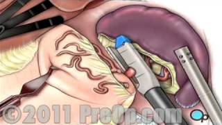 Spleen Removal Surgery Laparoscopic Splenectomy PreOp® Patient Education [upl. by Torras748]