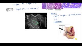 Endometrial Cancer and Hyperplasia for USMLE [upl. by Pascal244]