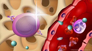 Waldenström’s Macroglobulinemia [upl. by Dragon]