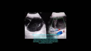 Retroperitoneal complex cystic lesion  hydatid disease  abscess [upl. by Ailegra]