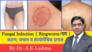 Ringworm Fungal Infection Complete information [upl. by Ayadahs]