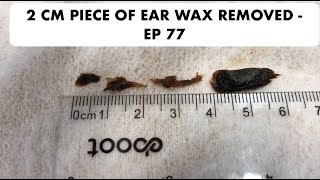 2 CM PIECE OF EAR WAX REMOVED  EP 77 [upl. by Mueller]