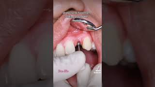 DENTAL IMPLANT HEALING ABUTMENT [upl. by Criswell485]