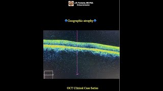 Geographic atrophy Atrophic agerelated macular degeneration [upl. by Certie]