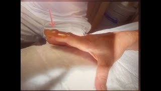 Paronychia Abscess Drainage A didactic video for young surgeons [upl. by Olnton306]