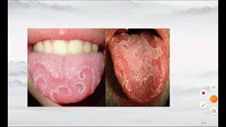 Glossitis  Types  Causes amp Risk Factor  Sign and Symptoms  Diagnosis  Management  Prevention [upl. by Arissa]