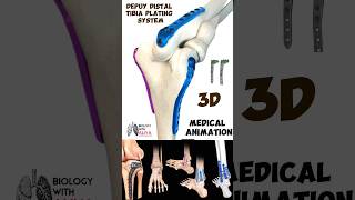 Depuy Distal Tibia Plating System medical 3d animation short biology With Aliya [upl. by Oicatsana]