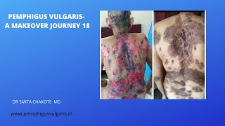 PEMPHIGUS VULGARIS A MAKEOVER JOURNEY 18 [upl. by Encratia]