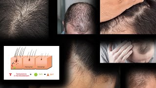 How DHT Damages The Hair Follicle [upl. by Flossy702]