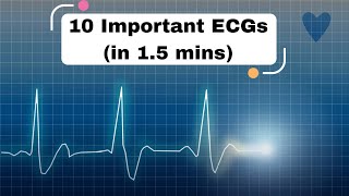 10 Important ECGs in 15 mins cardiology ecg ekg [upl. by Alyhc]