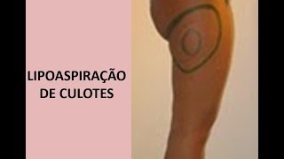 94 LIPOASPIRAÇÃO DE CULOTES CUIDADOS BÁSICOS [upl. by Allan804]